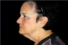 Facelift Before Photo by Landon Pryor, MD, FACS; Rockford, IL - Case 45884