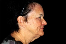 Facelift Before Photo by Landon Pryor, MD, FACS; Rockford, IL - Case 45884