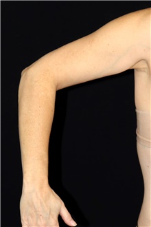 Liposuction After Photo by Landon Pryor, MD, FACS; Rockford, IL - Case 45885