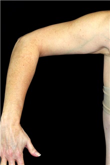 Liposuction Before Photo by Landon Pryor, MD, FACS; Rockford, IL - Case 45885