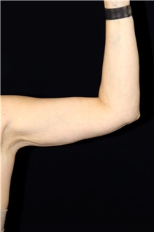 Liposuction After Photo by Landon Pryor, MD, FACS; Rockford, IL - Case 45885