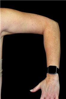 Liposuction Before Photo by Landon Pryor, MD, FACS; Rockford, IL - Case 45885