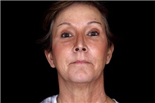 Brow Lift After Photo by Landon Pryor, MD, FACS; Rockford, IL - Case 45887