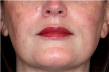 Lip Augmentation/Enhancement After Photo by Landon Pryor, MD, FACS; Rockford, IL - Case 45888