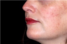 Lip Augmentation/Enhancement After Photo by Landon Pryor, MD, FACS; Rockford, IL - Case 45888