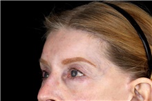 Brow Lift After Photo by Landon Pryor, MD, FACS; Rockford, IL - Case 45891
