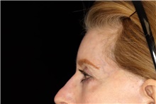 Brow Lift Before Photo by Landon Pryor, MD, FACS; Rockford, IL - Case 45891