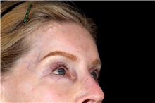 Brow Lift After Photo by Landon Pryor, MD, FACS; Rockford, IL - Case 45891