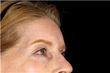 Brow Lift Before Photo by Landon Pryor, MD, FACS; Rockford, IL - Case 45891