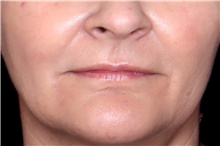 Injectable Fillers After Photo by Landon Pryor, MD, FACS; Rockford, IL - Case 45896