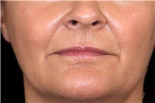 Injectable Fillers Before Photo by Landon Pryor, MD, FACS; Rockford, IL - Case 45896