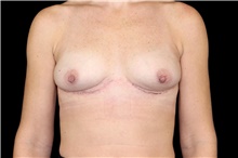 Breast Implant Removal After Photo by Landon Pryor, MD, FACS; Rockford, IL - Case 45897