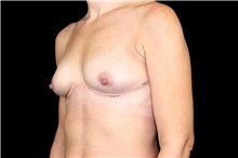 Breast Implant Removal After Photo by Landon Pryor, MD, FACS; Rockford, IL - Case 45897