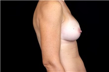 Breast Implant Removal Before Photo by Landon Pryor, MD, FACS; Rockford, IL - Case 45897