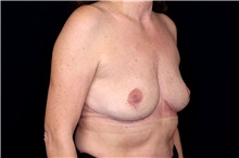 Breast Implant Removal After Photo by Landon Pryor, MD, FACS; Rockford, IL - Case 45898