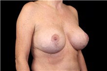 Breast Implant Removal Before Photo by Landon Pryor, MD, FACS; Rockford, IL - Case 45898