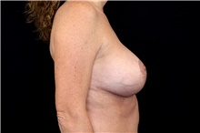 Breast Implant Removal Before Photo by Landon Pryor, MD, FACS; Rockford, IL - Case 45898