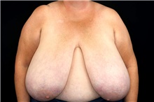 Breast Reduction Before Photo by Landon Pryor, MD, FACS; Rockford, IL - Case 45899