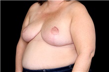 Breast Reduction After Photo by Landon Pryor, MD, FACS; Rockford, IL - Case 45899