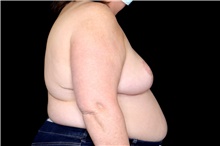 Breast Reduction After Photo by Landon Pryor, MD, FACS; Rockford, IL - Case 45899