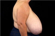 Breast Reduction Before Photo by Landon Pryor, MD, FACS; Rockford, IL - Case 45899