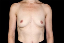Breast Augmentation Before Photo by Landon Pryor, MD, FACS; Rockford, IL - Case 47449