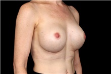 Breast Augmentation After Photo by Landon Pryor, MD, FACS; Rockford, IL - Case 47449