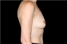 Breast Augmentation Before Photo by Landon Pryor, MD, FACS; Rockford, IL - Case 47449