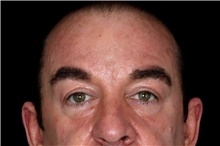 Eyelid Surgery After Photo by Landon Pryor, MD, FACS; Rockford, IL - Case 47451