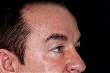 Eyelid Surgery After Photo by Landon Pryor, MD, FACS; Rockford, IL - Case 47451