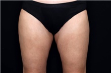 Thigh Lift After Photo by Landon Pryor, MD, FACS; Rockford, IL - Case 47452