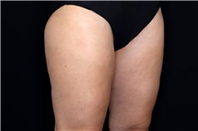 Thigh Lift After Photo by Landon Pryor, MD, FACS; Rockford, IL - Case 47452