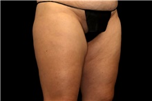 Thigh Lift Before Photo by Landon Pryor, MD, FACS; Rockford, IL - Case 47452