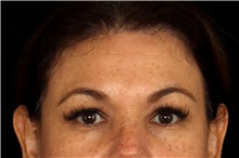 Brow Lift Before Photo by Landon Pryor, MD, FACS; Rockford, IL - Case 47453