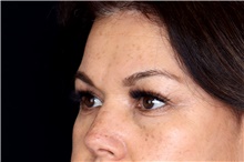 Brow Lift After Photo by Landon Pryor, MD, FACS; Rockford, IL - Case 47453