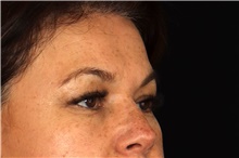 Brow Lift Before Photo by Landon Pryor, MD, FACS; Rockford, IL - Case 47453