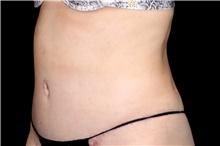 Tummy Tuck After Photo by Landon Pryor, MD, FACS; Rockford, IL - Case 47454
