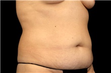 Tummy Tuck Before Photo by Landon Pryor, MD, FACS; Rockford, IL - Case 47454