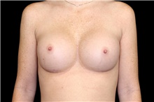 Breast Augmentation After Photo by Landon Pryor, MD, FACS; Rockford, IL - Case 47458