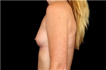 Breast Augmentation Before Photo by Landon Pryor, MD, FACS; Rockford, IL - Case 47458