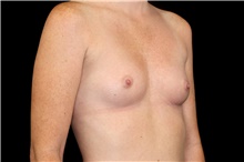 Breast Augmentation Before Photo by Landon Pryor, MD, FACS; Rockford, IL - Case 47458