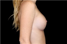 Breast Augmentation After Photo by Landon Pryor, MD, FACS; Rockford, IL - Case 47458