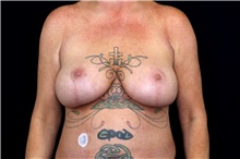 Breast Lift After Photo by Landon Pryor, MD, FACS; Rockford, IL - Case 47460