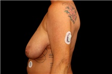 Breast Lift Before Photo by Landon Pryor, MD, FACS; Rockford, IL - Case 47460