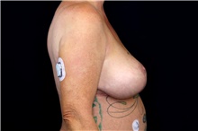 Breast Lift After Photo by Landon Pryor, MD, FACS; Rockford, IL - Case 47460