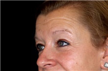 Eyelid Surgery Before Photo by Landon Pryor, MD, FACS; Rockford, IL - Case 47462