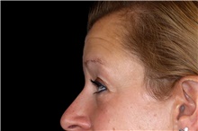 Eyelid Surgery Before Photo by Landon Pryor, MD, FACS; Rockford, IL - Case 47462