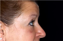 Eyelid Surgery After Photo by Landon Pryor, MD, FACS; Rockford, IL - Case 47462