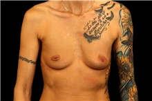 Breast Augmentation Before Photo by Landon Pryor, MD, FACS; Rockford, IL - Case 47463