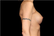 Breast Augmentation After Photo by Landon Pryor, MD, FACS; Rockford, IL - Case 47463